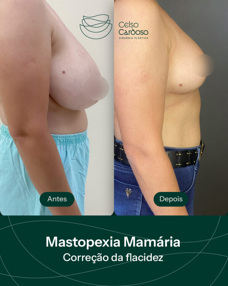 Antes e depois de Mastopexia em Santa Maria RS Dr Celso Cardoso