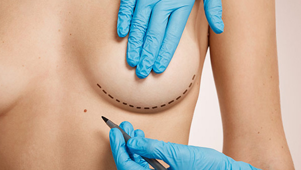 Mamoplastia de Aumento Prótese de Silicone Santa Maria RS