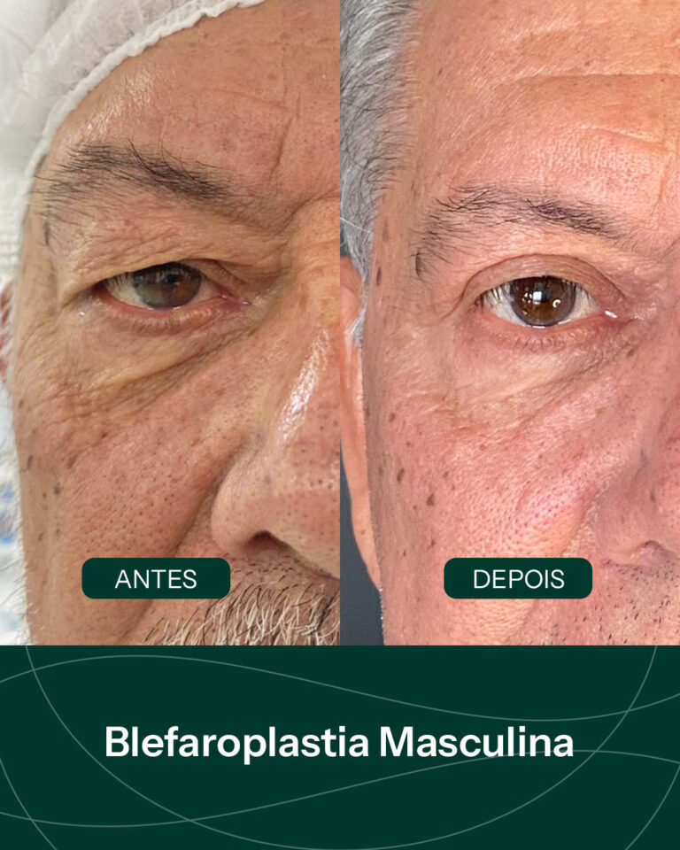 Antes e depois de blefaroplastia masculina em Santa Maria RS Dr Celso Cardoso