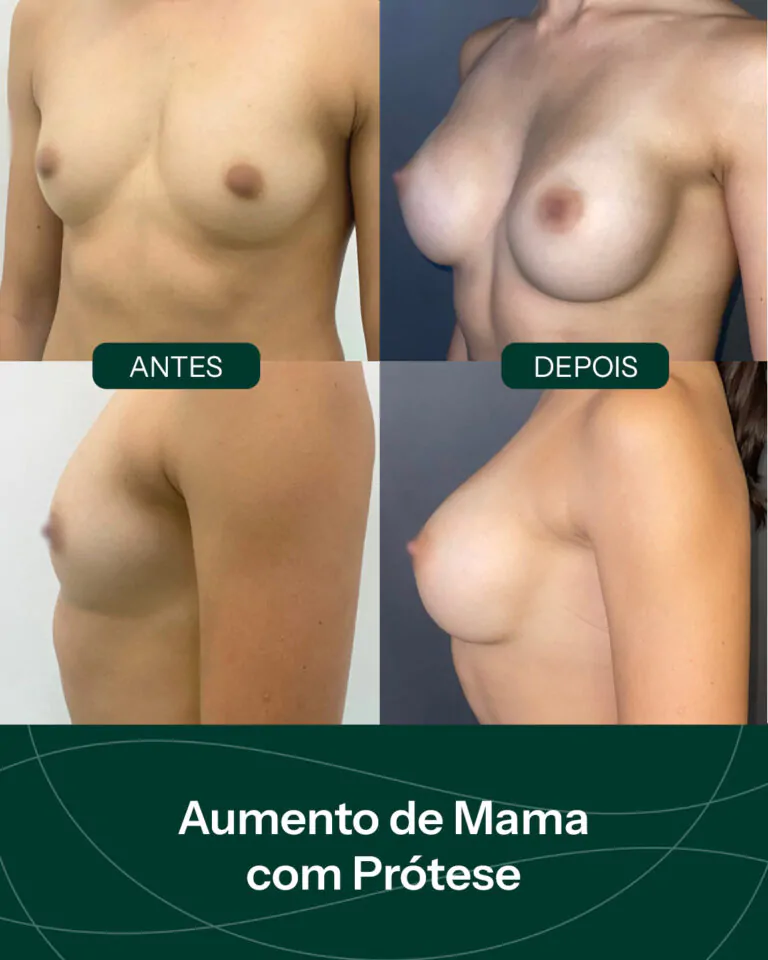 Resultado de prótese de silicone em Santa Maria RS Dr Celso Cardoso